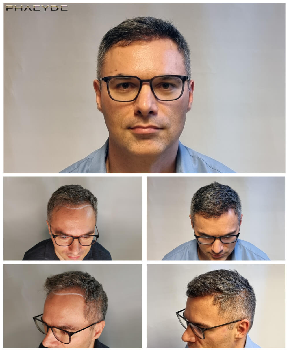 Pavel – 1400 Enxertos